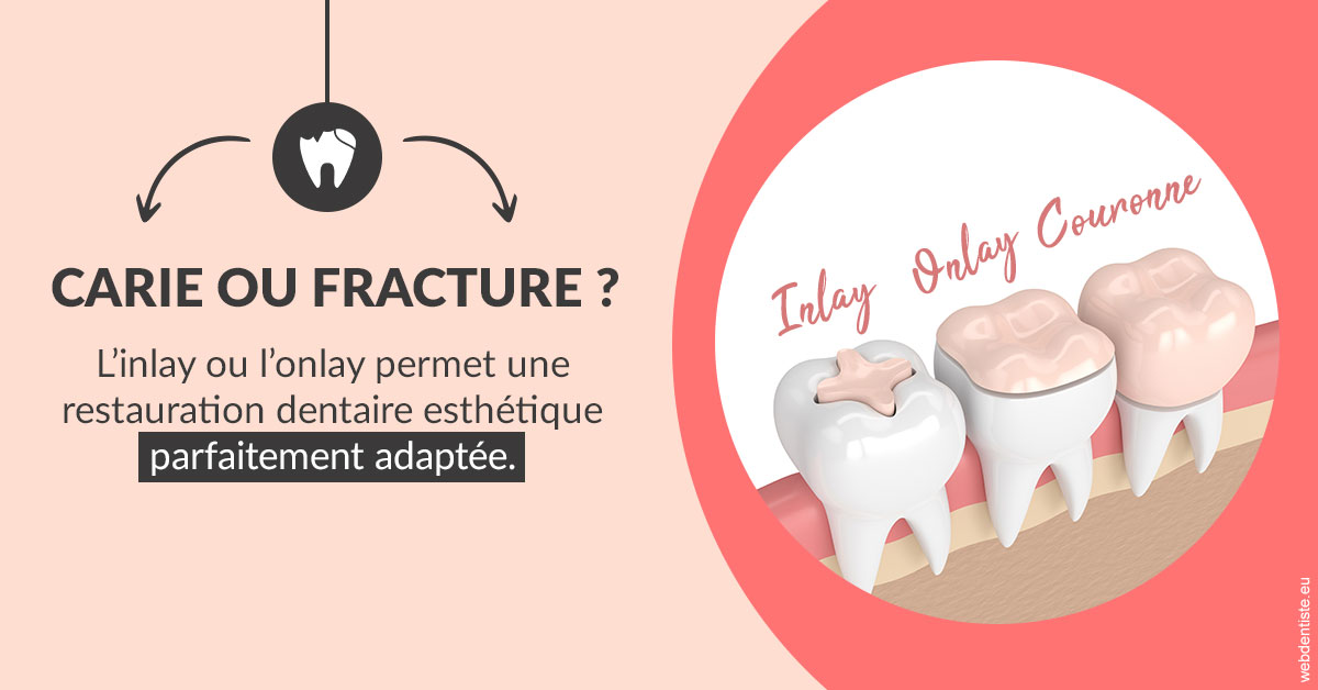 https://www.marcbodsondentiste.be/T2 2023 - Carie ou fracture 2