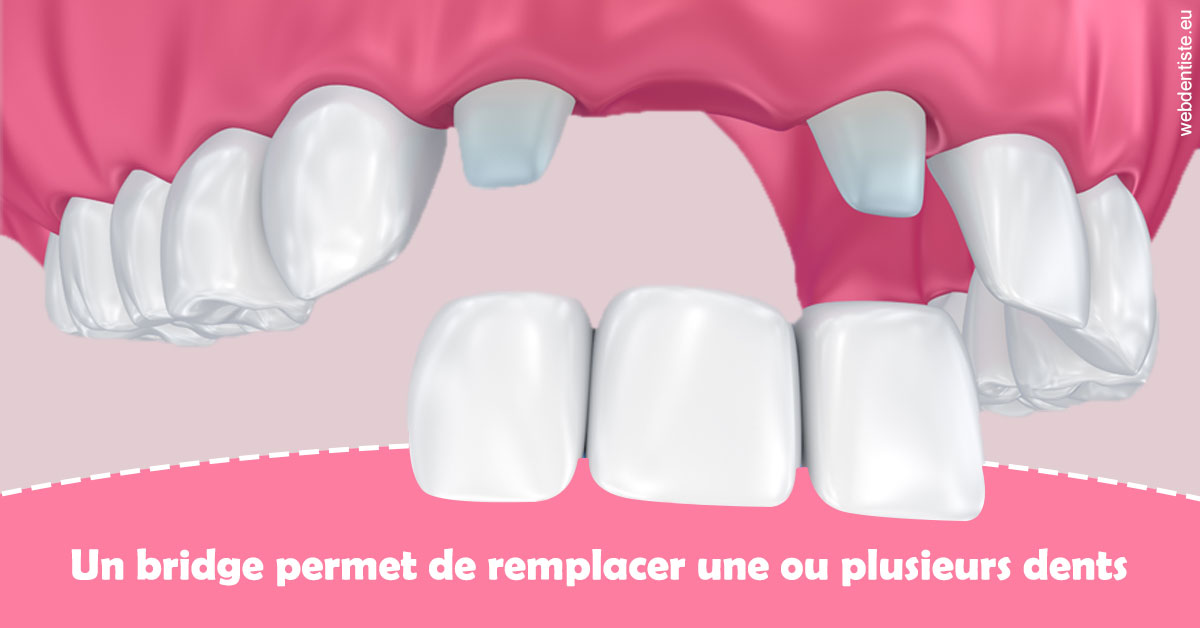 https://www.marcbodsondentiste.be/Bridge remplacer dents 2
