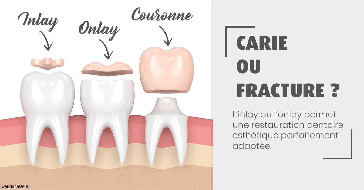https://www.marcbodsondentiste.be/T2 2023 - Carie ou fracture 1