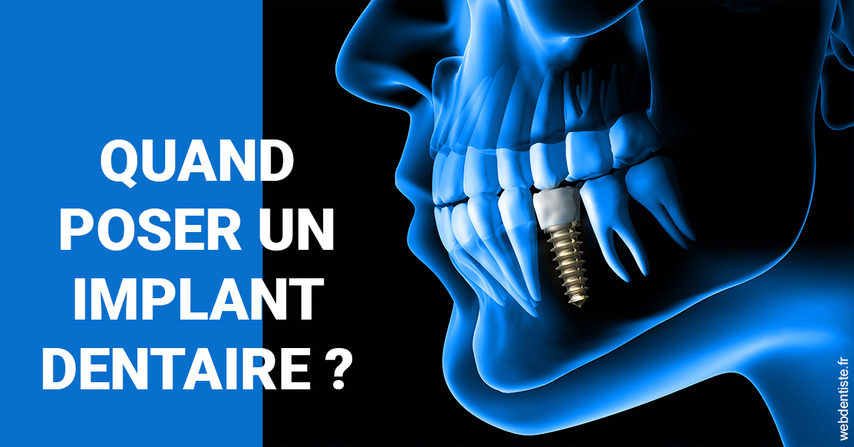 https://www.marcbodsondentiste.be/Les implants 1