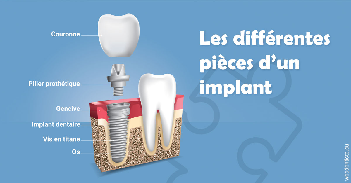 https://www.marcbodsondentiste.be/Les différentes pièces d’un implant 1